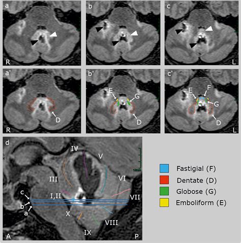 Frontiers | Bilateral lesion of the cerebellar fastigial nucleus ...