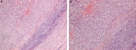 Histology of angiomatoid fibrous histiocytoma. (a) Histological... | Download Scientific Diagram