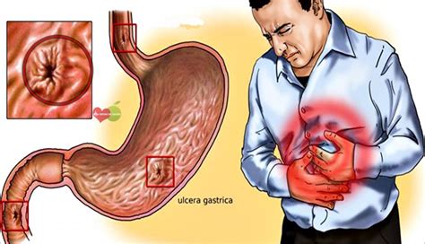 Úlcera Gástrica - O que é, Causas e Tratamentos | Dicas de Saúde