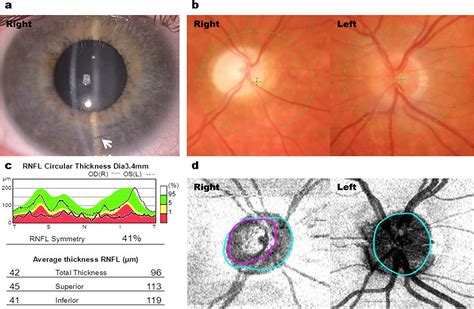 Long-term outcomes in Primary congenital glaucoma, aniridia and ...