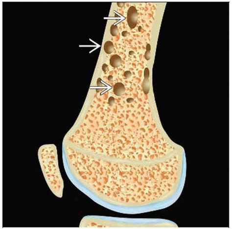 Multiple Myeloma Punched Out Lesions