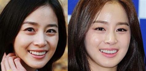 Kim Tae Hee Plastic Surgery Before And After Face Photos