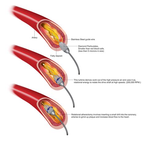 Atherectomy Dallas, TX | Fort Worth Atherectomy