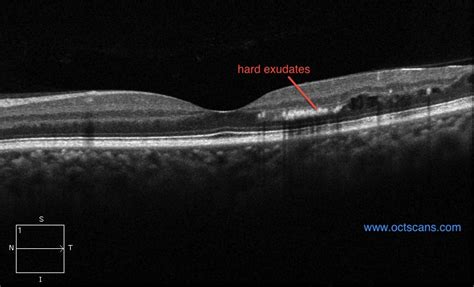 Diabetic Retinopathy - Optical Coherence Tomography Scans