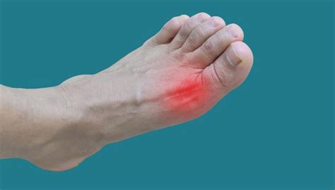 Gout On Sole Of Foot Sale | emergencydentistry.com