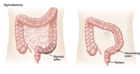 Types of Colon Resections | Saint Luke's Health System