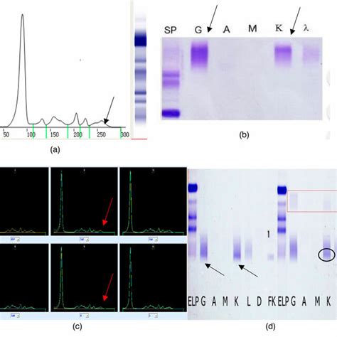 The results of serum protein electrophoresis, immunofixation... | Download Scientific Diagram