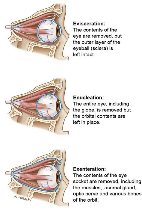 Enucleation And Evisceration: What To Expect, 52% OFF