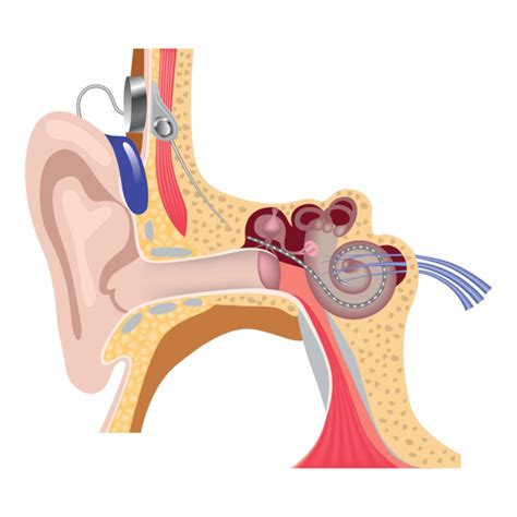 Sensorineural Hearing Loss: Comprehensive Guide, Causes, and Treatment ...