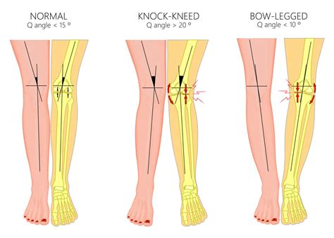 An Introduction to Gait and Gait Abnormalities - AposHealth®