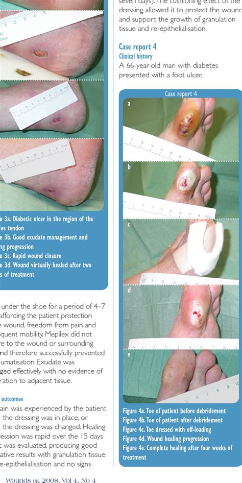 Figure 4 from Management of diabetic foot ulcers using dressings with Safetac ® : a review of ...