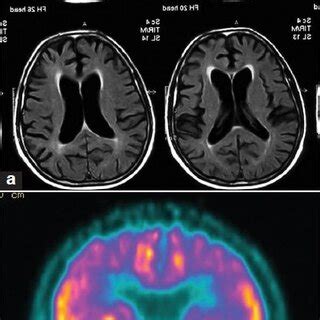 (a) MRI brain T1W axial image showing diffuse atrophy in a 58-year-old ...