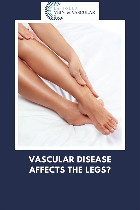 Vein & Vascular Treatment | Vascular Disease & Legs