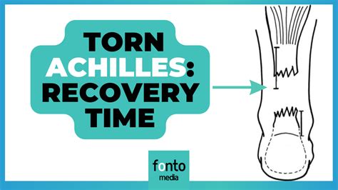 Torn Achilles: Recovery Time and Tips from Physiotherapist!