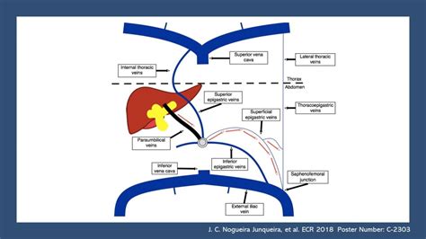 Patent paraumbilical vein(s) in portal hypertension – NephroPOCUS