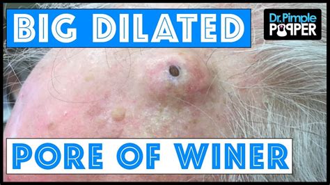 The Biggest Dilated Pore of Winer?! - YouTube