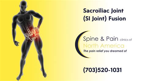 Sacroiliac Joint (SI Joint) Fusion at SAPNA: Spine and Pain Clinic of ...