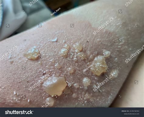 Leg Burn Blisters Burning Boiling Water Stock Photo 2176730763 ...