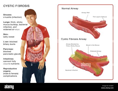 Cystic Fibrosis Lungs Comparison