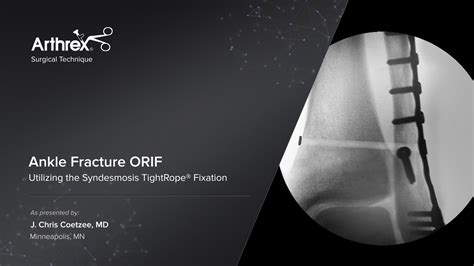 Arthrex - Ankle Fracture ORIF Utilizing the Syndesmosis TightRope® Fixation