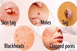 Remove Moles, Warts, Blackheads, Skin Tags and Age Spots with These ...