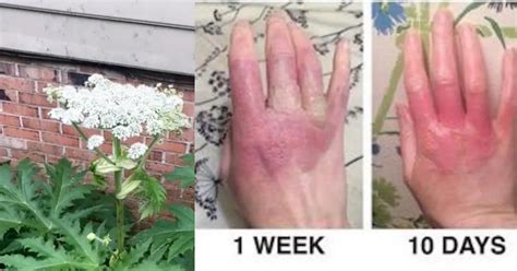 Hogweed Plant That Causes Severe Burns & Blindness Is Sweeping America