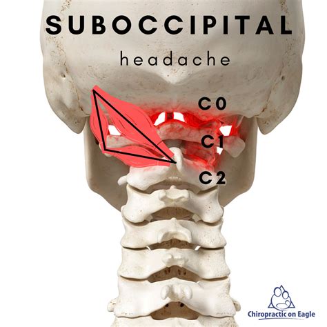 Cervicogenic Headaches - Chiropractic on Eagle, Dr. Jon Saunders