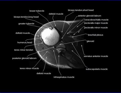 Shoulder Joint Anatomy Mri