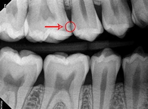 What Does a Cavity Look Like on an X-Ray? - Web DMD