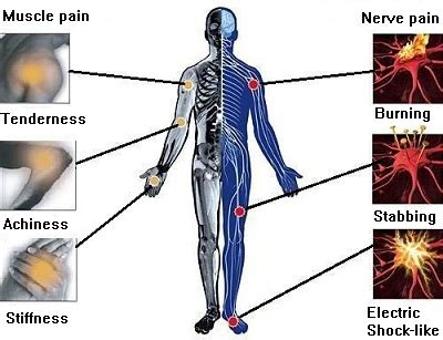 Acupuncture for Sciatica Pain - TCM Health Care