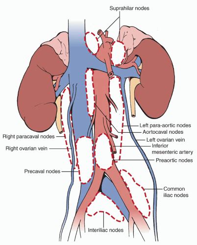 Para Aortic Lymph Node Removal