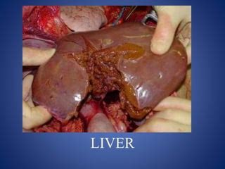 Liver trauma | PPT