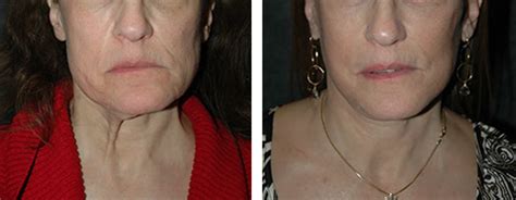 Platysmaplasty | Platysmaplasty Before and After Photos