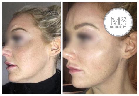 jawline contouring - Dr MediSpa Essex & London | Dr MediSpa Essex & London