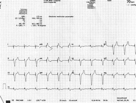 Atrial fibrillation in ventricular-paced rhythm: under-recognised, underdiagnosed and ...