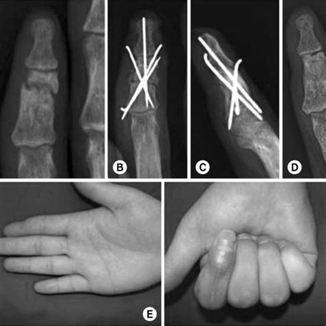 A 39-year-old woman sustained multiple open fracture and dislocation of... | Download Scientific ...