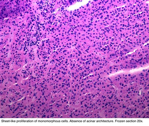 Pathology Outlines - Pituitary adenoma