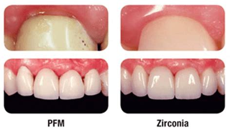 Zirconia vs Porcelain Crowns: Choosing the Right Option for Your Smile