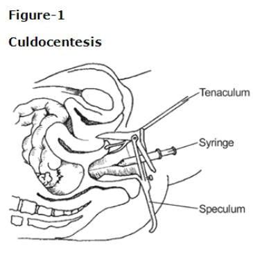 Culdocentesis: Overview, Indications, Contraindications