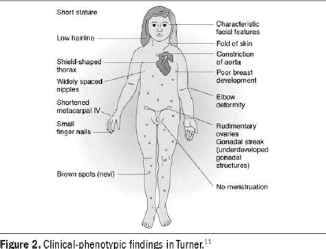 [PDF] Y chromosome in Turner syndrome: review of the literature ...