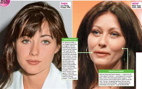 Shannen Doherty Plastic Surgery Before and After Botox Injections, Nose ...