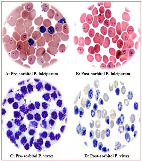 A-D): Showing Plasmodium falciparum and Plasmodium vivax before and... | Download Scientific Diagram