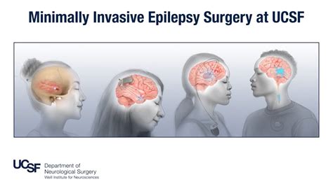 Brain Surgery Epilepsy