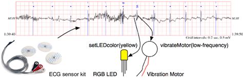 An occurrence of supraventricular premature or ectopic beat, which is... | Download Scientific ...