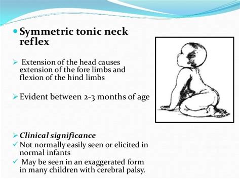 Symmetric Tonic Neck Reflex - slidesharetrick