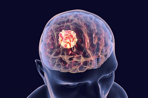 Brain Tumor Stages | TNM Stages and Metastasis | Onco.com
