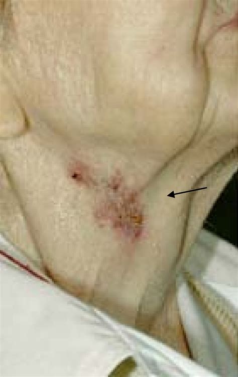 Recurrent neck abscesses due to cervical tuberculous lymphadenopathy in an elderly woman post ...