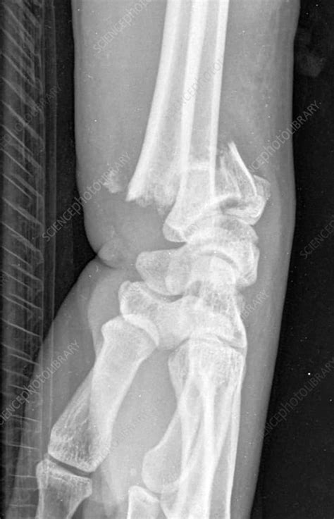 Colles fracture, X-ray - Stock Image - F034/8219 - Science Photo Library