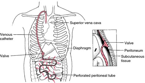 Pulmonary shunt | definition of Pulmonary shunt by Medical dictionary