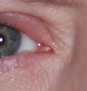 Eyes infections - Blocked tear duct | Eye Disorders and Diseases ...